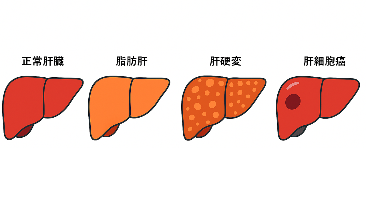 肝臓の進行図:正常肝、脂肪肝、肝硬変、肝細胞がんの4段階をイラストで示した図